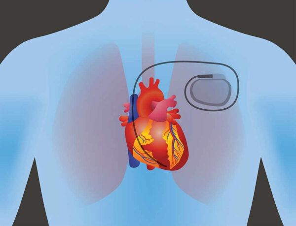جهاز تنظيم ضربات القلب