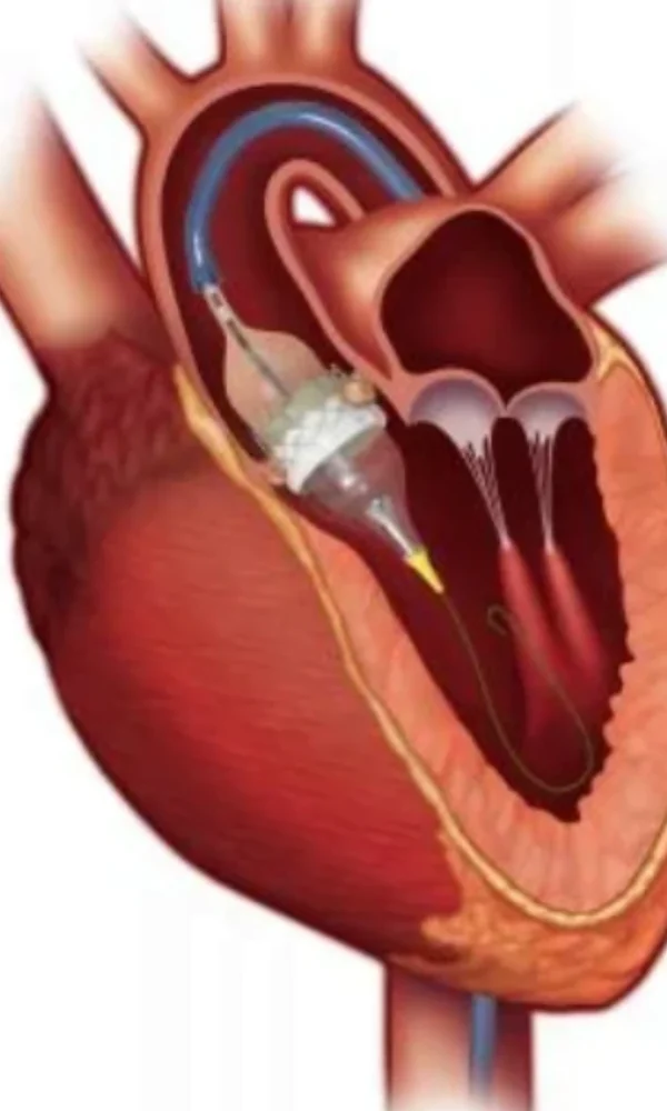 تكلفة عملية تغيير الصمام الأورطي