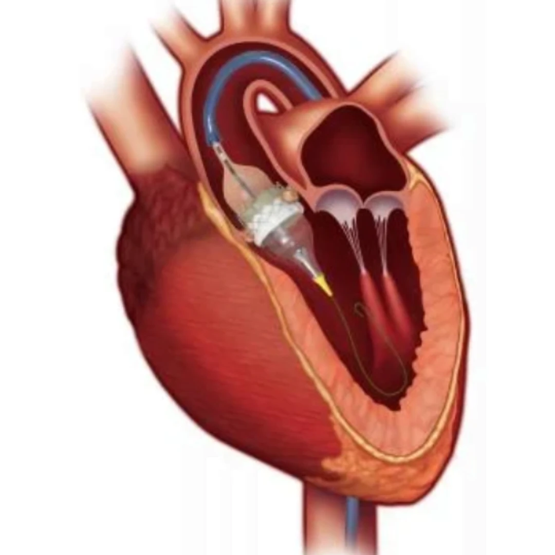 تكلفة عملية تغيير الصمام الأورطي