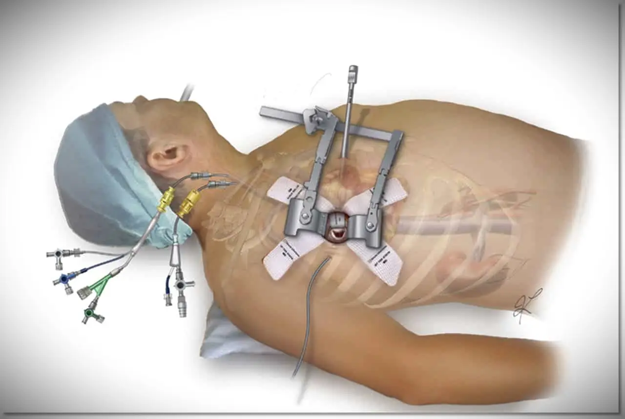 تغيير الصمام الميترالي بالقسطرة