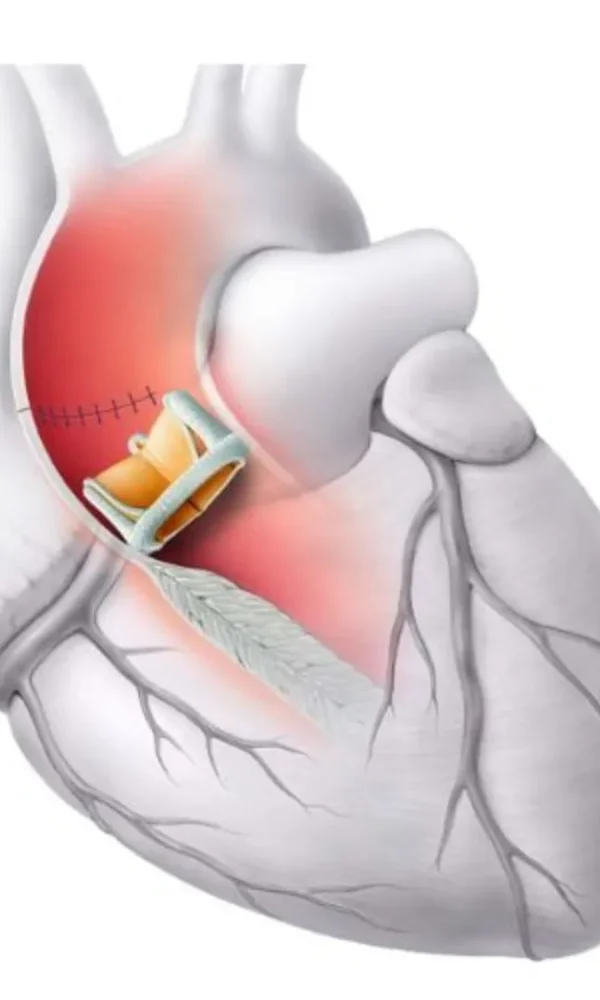 تكلفة عملية تغيير الصمام الميترالي