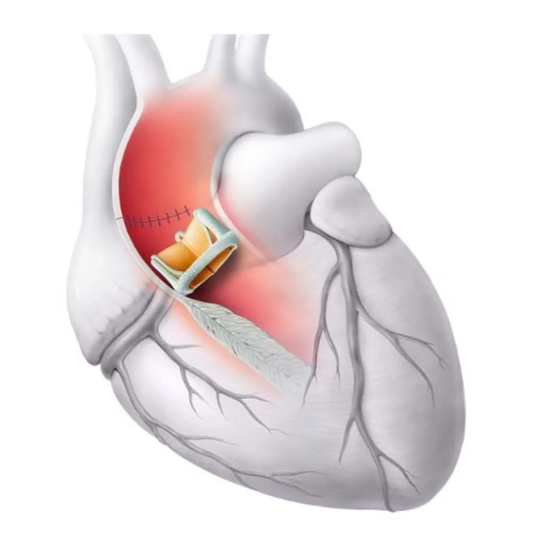 تكلفة عملية تغيير الصمام الميترالي
