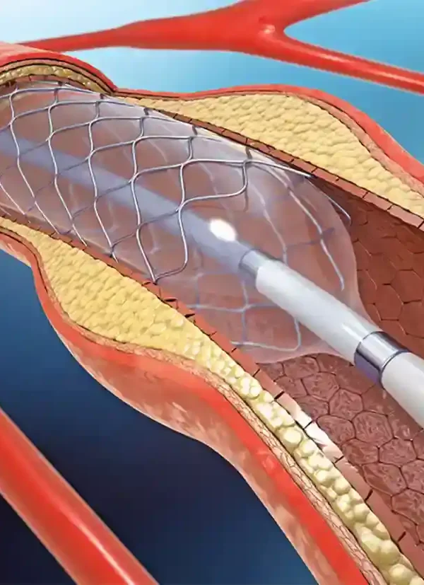 تكلفة عملية دعامة القلب
