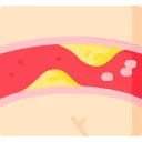 انسداد الشرايين