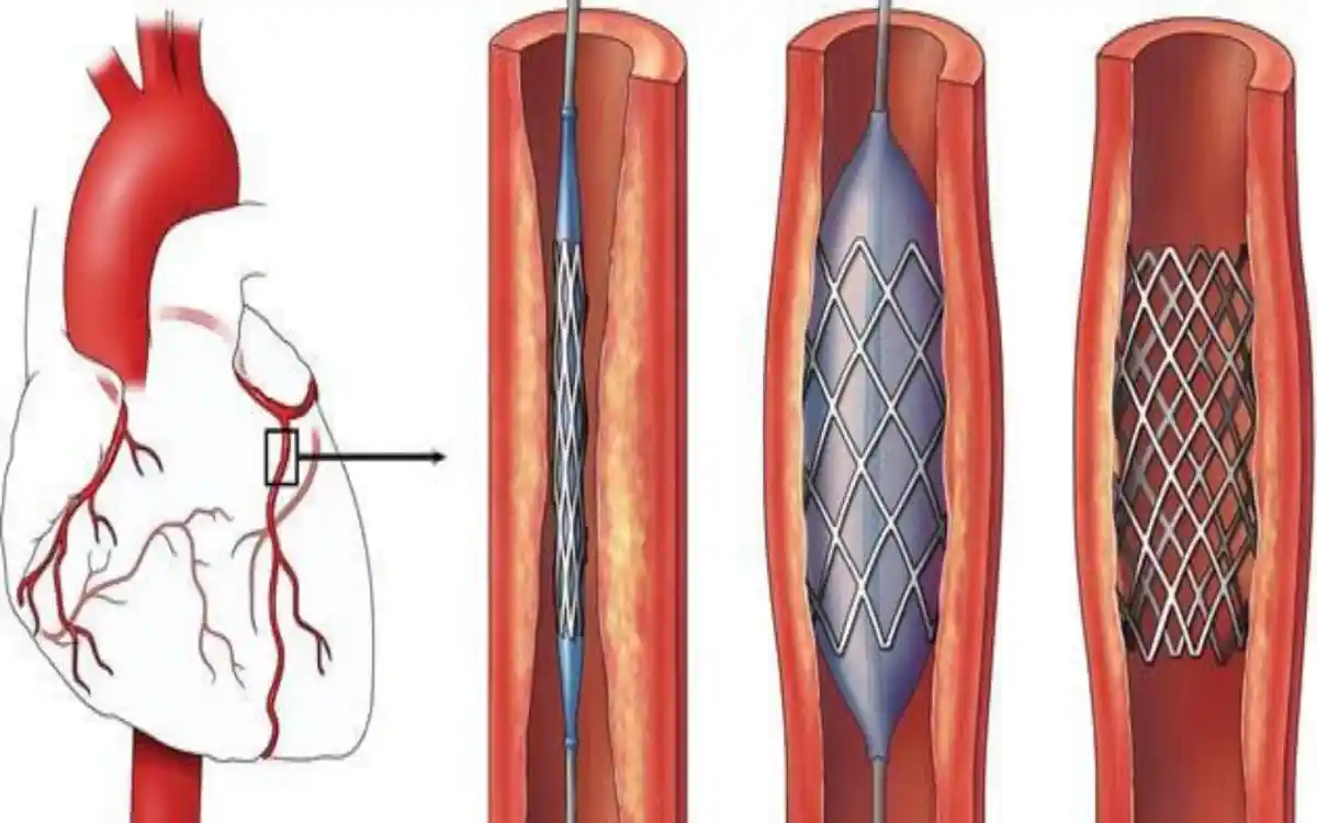 القسطرة القلبية - دكتور عمرو امام افضل دكتور قلب في التجمع الخامس