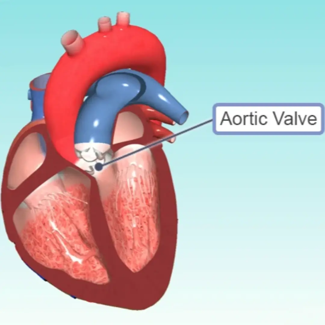 تغيير الصمام الأورطي بالقسطرة