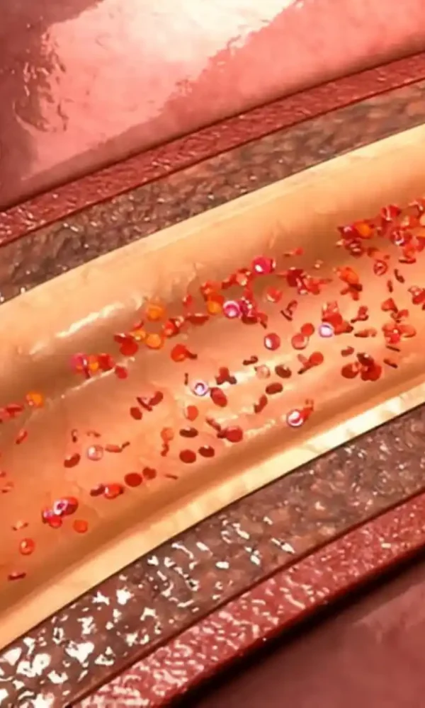 علاج ترسب الكالسيوم في الشرايين