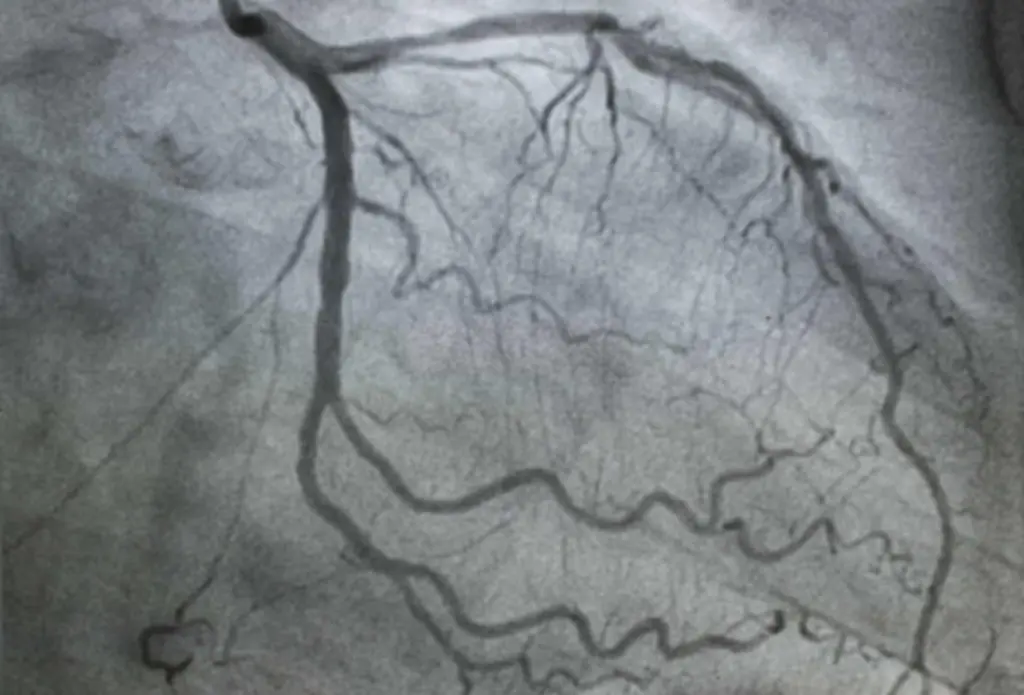 انسداد الشريان